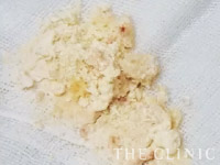 石灰化した被膜