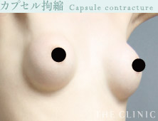 カプセル拘縮の症例